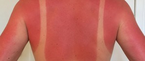 Hver anden dansker bliver solskoldet på sommerferien i Danmark