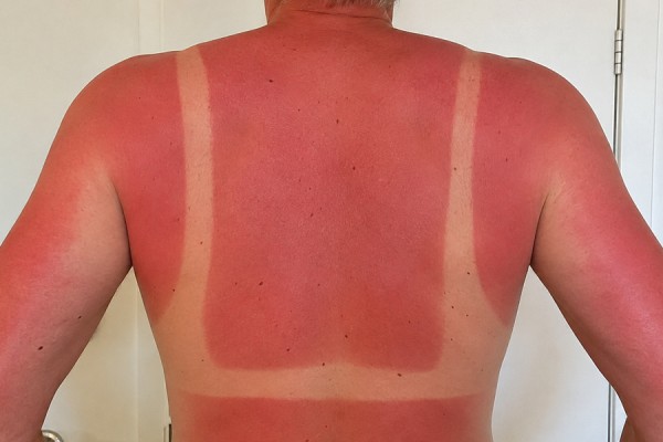 Hver anden dansker bliver solskoldet på sommerferien i Danmark